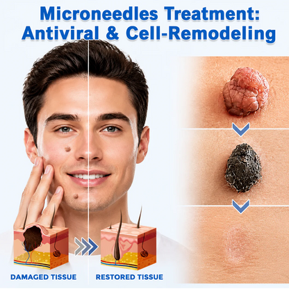 🎉🎉𝐇𝐢𝐬𝐤𝐢𝐧® 2-in-1 Microneedle & Hydrocolloid Patch | Removes raised moles, acne, flat warts, and skin tags | Helps improve wrinkles, scars, and blemishes | Invisible patches for face and body