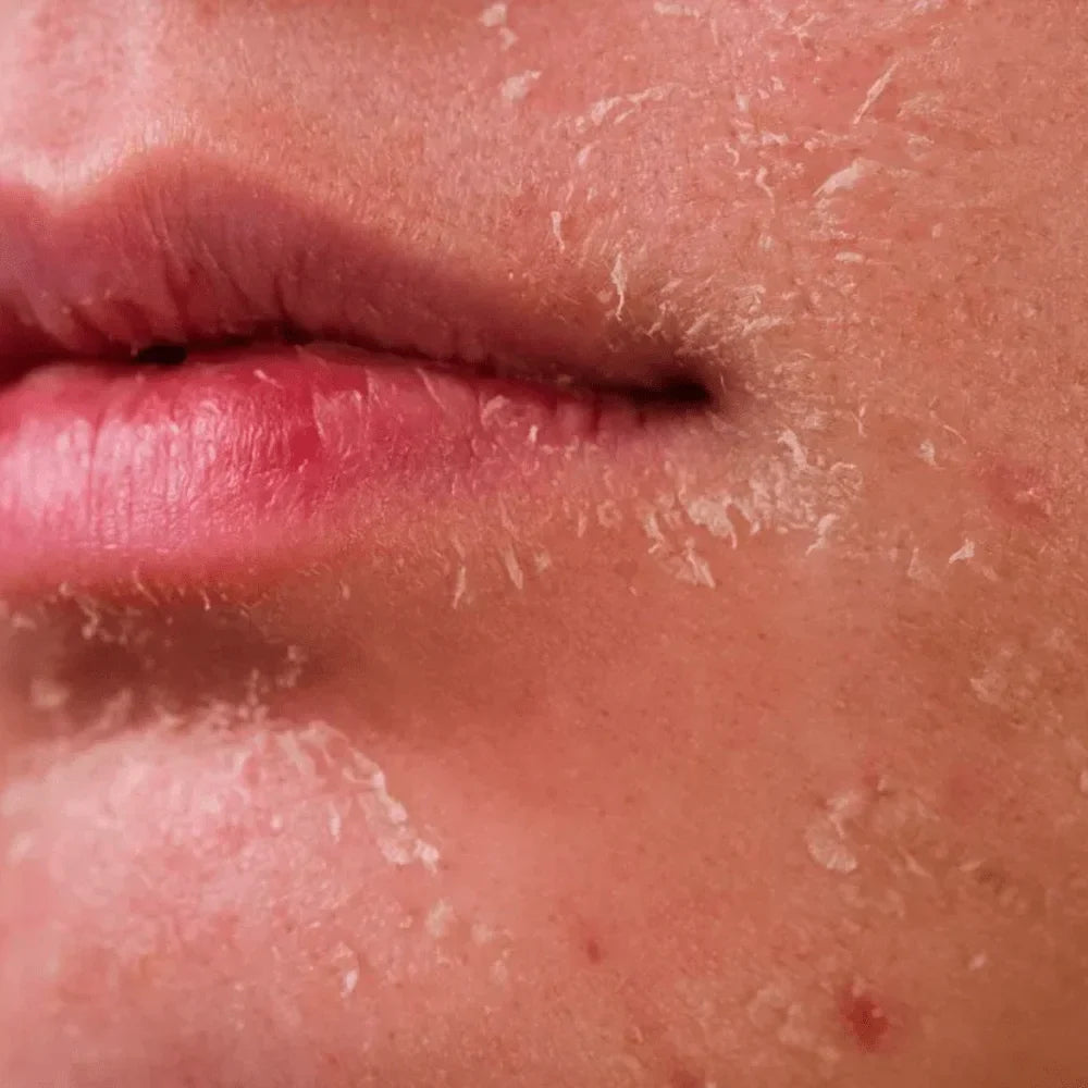 Dryness & dehydration
