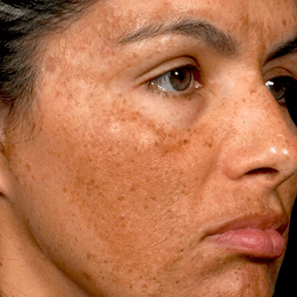 Dark Spots & Dark Circles