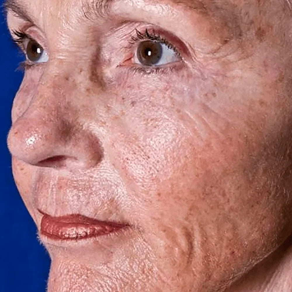 Sun-Damaged Skin