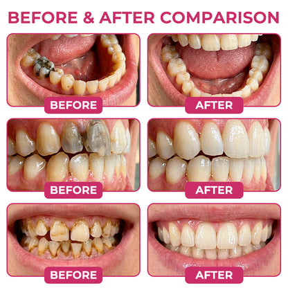 Rolimey® Natural Enamel Restoration Gel – Cavity & Micro-Crack Repair