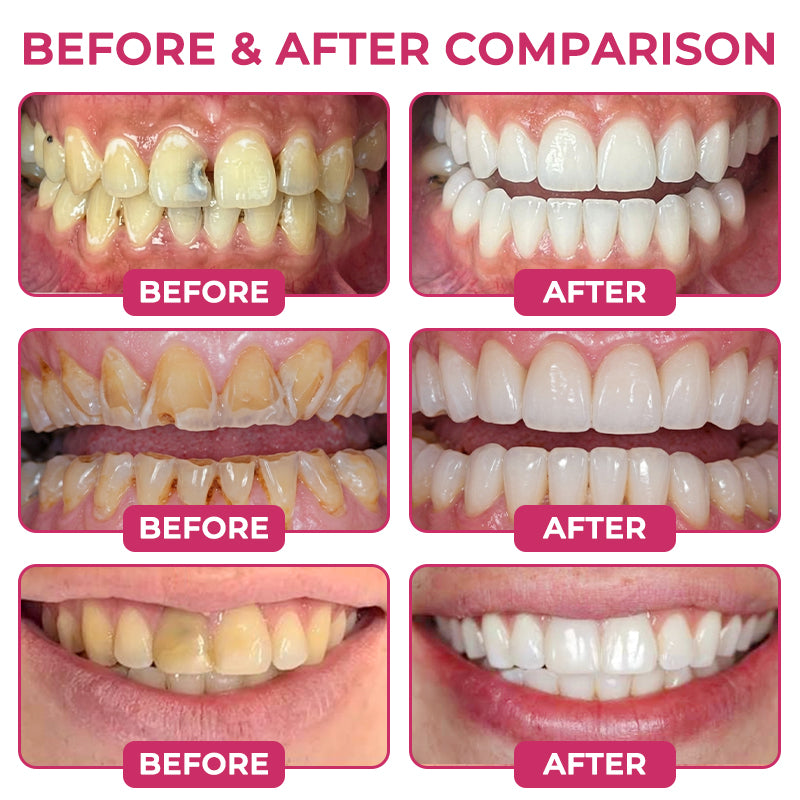 Rolimey® Natural Enamel Restoration Gel – Cavity & Micro-Crack Repair