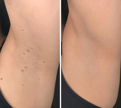 🎉🎉𝐇𝐢𝐬𝐤𝐢𝐧® 2-in-1 Microneedle & Hydrocolloid Patch | Removes raised moles, acne, flat warts, and skin tags | Helps improve wrinkles, scars, and blemishes | Invisible patches for face and body