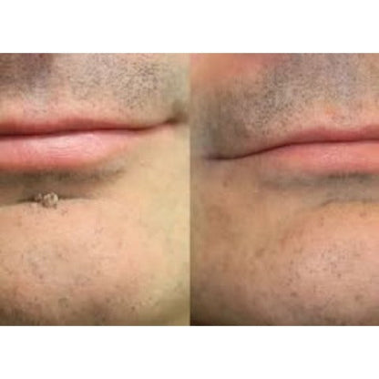 🎉🎉𝐇𝐢𝐬𝐤𝐢𝐧® 2-in-1 Microneedle & Hydrocolloid Patch | Removes raised moles, acne, flat warts, and skin tags | Helps improve wrinkles, scars, and blemishes | Invisible patches for face and body