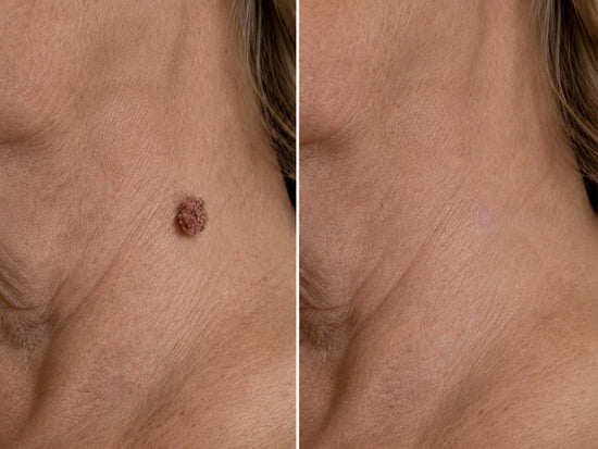 🎉🎉𝐇𝐢𝐬𝐤𝐢𝐧® 2-in-1 Microneedle & Hydrocolloid Patch | Removes raised moles, acne, flat warts, and skin tags | Helps improve wrinkles, scars, and blemishes | Invisible patches for face and body