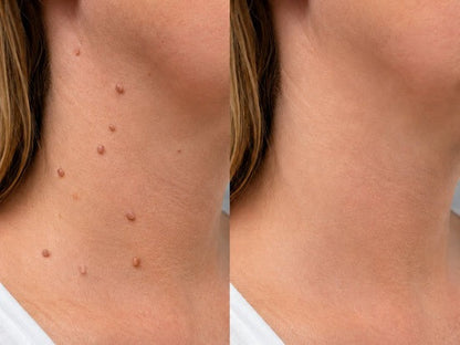 🎉🎉𝐇𝐢𝐬𝐤𝐢𝐧® 2-in-1 Microneedle & Hydrocolloid Patch | Removes raised moles, acne, flat warts, and skin tags | Helps improve wrinkles, scars, and blemishes | Invisible patches for face and body