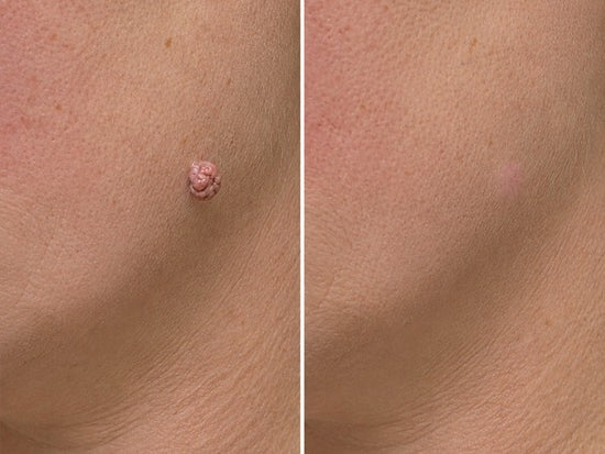 🎉🎉𝐇𝐢𝐬𝐤𝐢𝐧® 2-in-1 Microneedle & Hydrocolloid Patch | Removes raised moles, acne, flat warts, and skin tags | Helps improve wrinkles, scars, and blemishes | Invisible patches for face and body